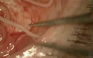 Illustration for article titled Watch a five-inch worm being pulled from a man's eyeball